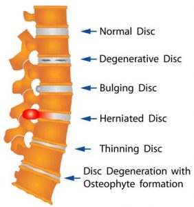 Degenerative-Disc-Disease