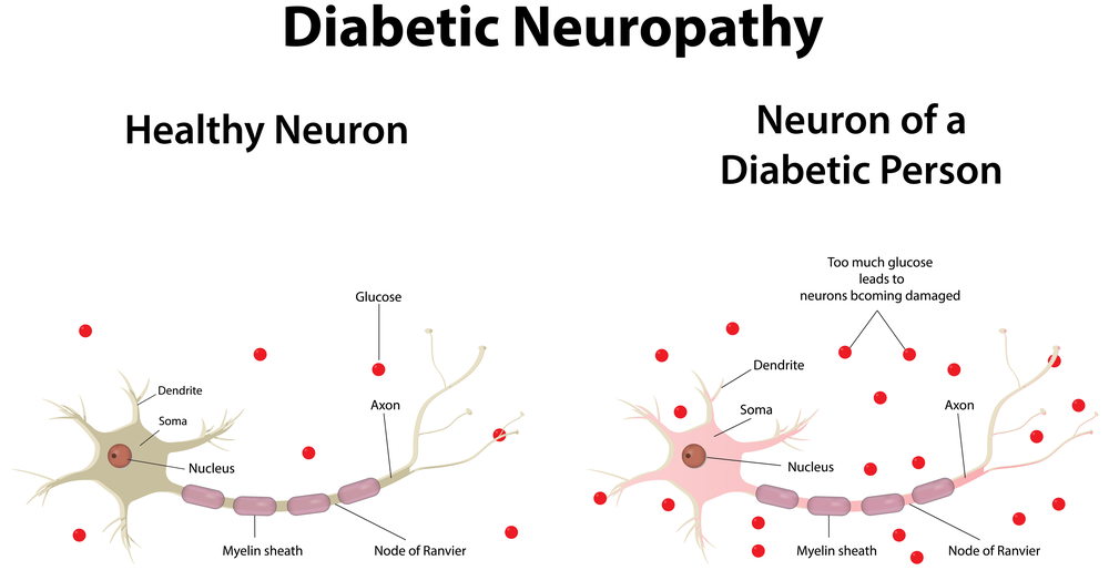 diabetic-neuropathic-pain