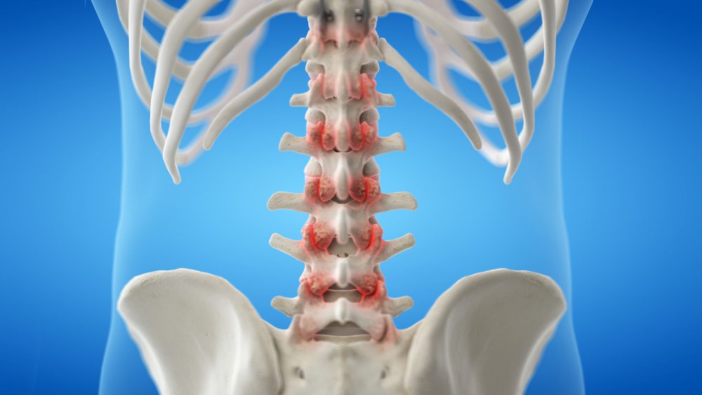  facet-joint-arthropathy