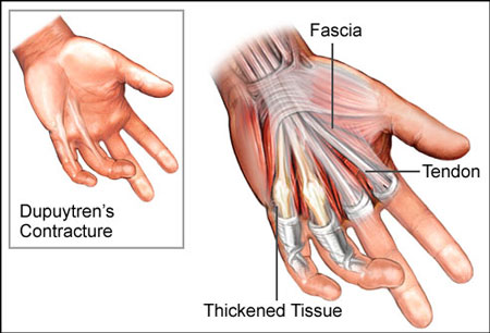 Dupuytren Contractures