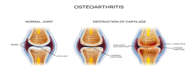 Osteoarthritis