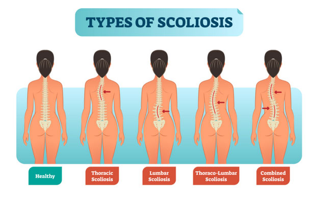 Scoliosis