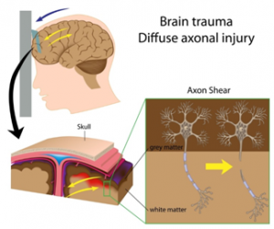 Diffuse Axonal Injury 