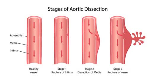 Aortic-Dissection