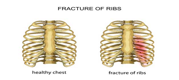 fractured-rib