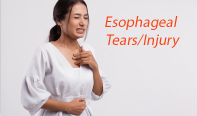 Esophageal cancer