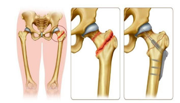 Femoral Neck Stress Fracture