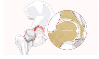 Labral tears/torn labrum