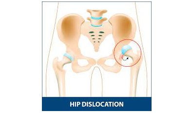 Hip Dislocation