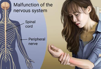 Complex Regional Pain Syndrome