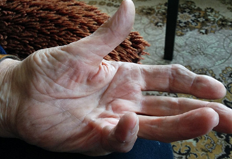 Dupuytren’s Contracture