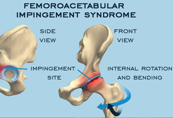 Femoroacetabular Impingement (FAI)