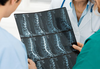 Spondylosis and Spondylolisthesis