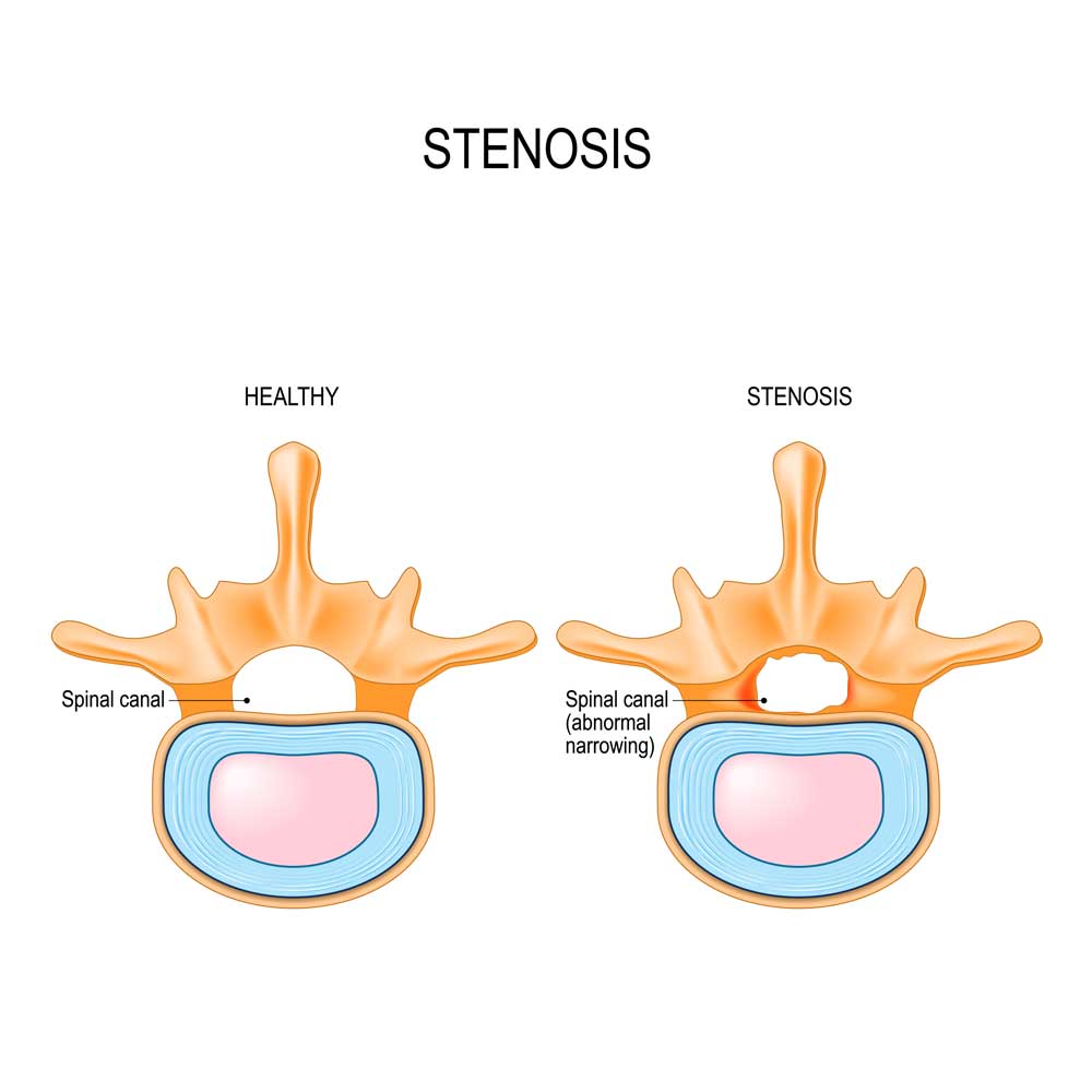 Spinal Stenosis