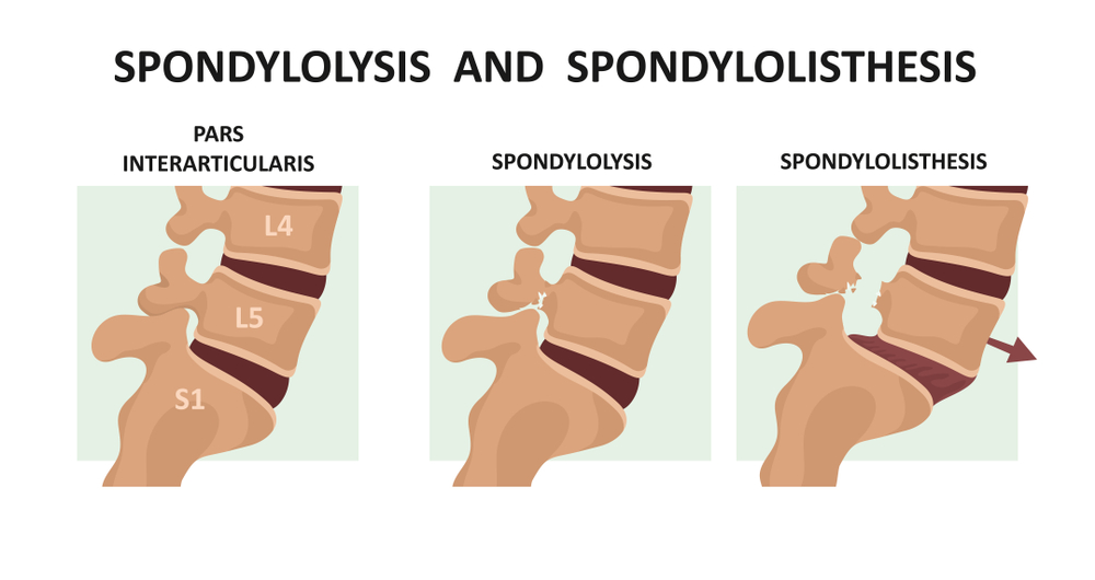 spondylosis-health