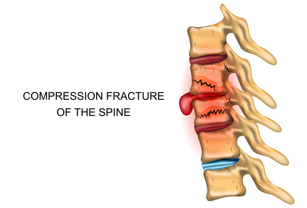 Osteoporotic Compression Fractures