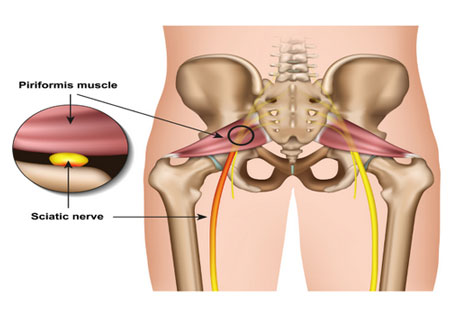 Sciatic Nerve Pain