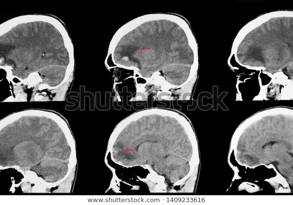 Intracerebral Contusions.