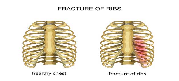 fractured-rib