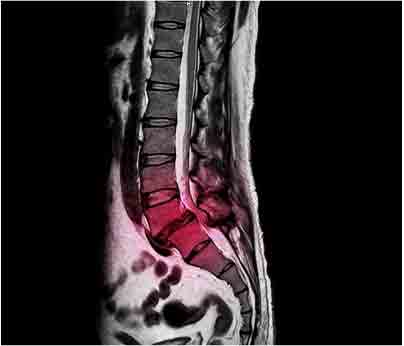 lumbar-spine