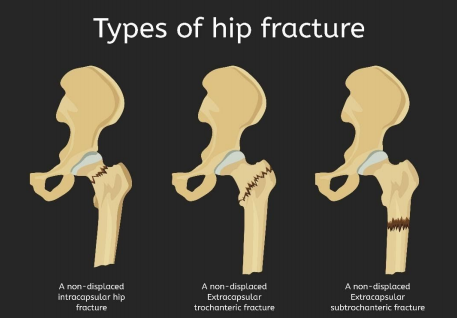 hip-fracture