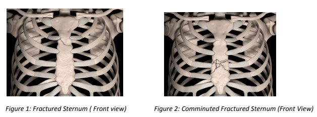 Fractured Sternum
