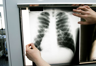 Hemothorax and a Pneumothorax