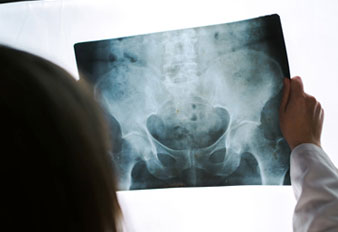 Pelvic Apophyseal Avulsion Fracture